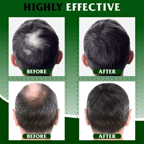 3 Herbal Hair Growth Spray Cabelo Essencial Óleo Perda De Ca