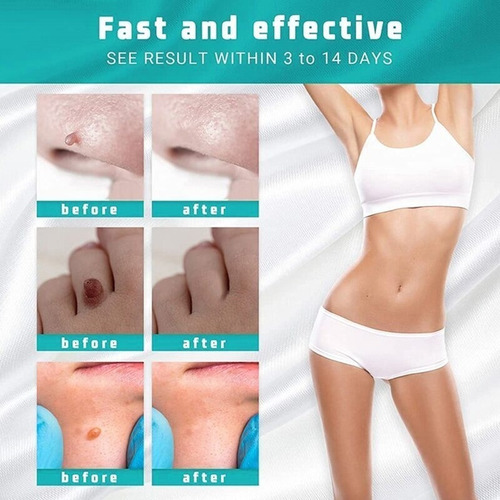 Z 2 Peças De Removedor De Creme Instantâneo Para Sardas