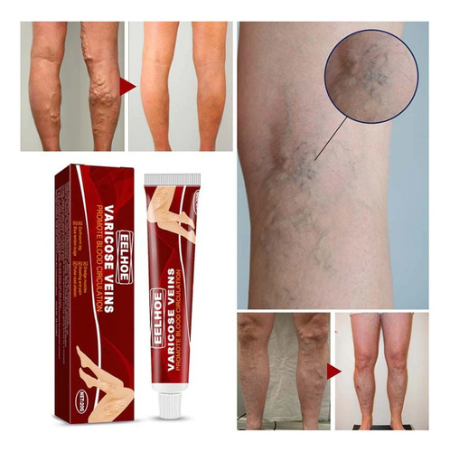 Crema Para Eliminar Venas Varicosas 20g