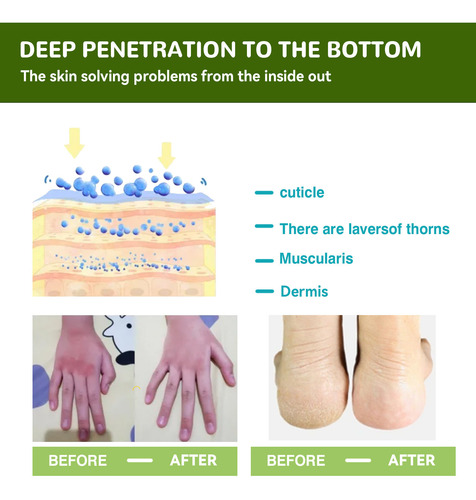 Creme De Ureia: Creme Para Mãos E Pés, Hidratante, Hidratant