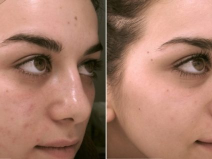 Imagen 2 de 4 de Ac. Mandelico 50% + Ac. Glicolico 50% Combo Peeling X30ml.