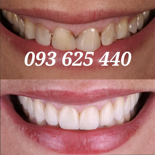 Imagen 2 de 4 de Implantes Dentales Protesis Estética Facial