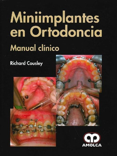 Libro Miniimplantes En Ortodoncia De Richard Cousley