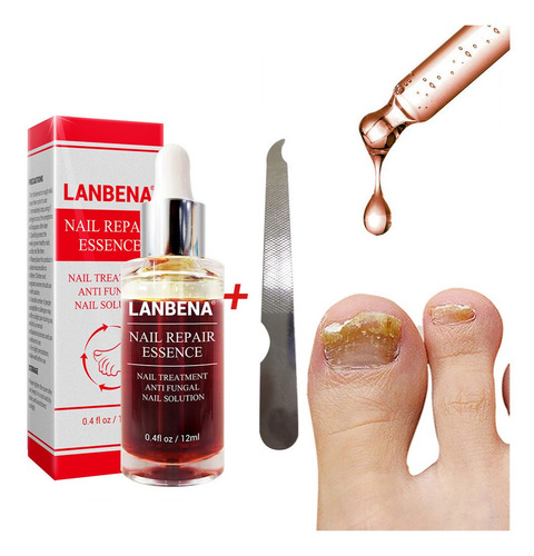 Tratamento De Unhas Fungo Remove Onicomicose Dedo Do Pé 15ml