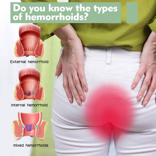 Una Crema Para Hemorroides Para Eliminar Las Hemorroides Rot