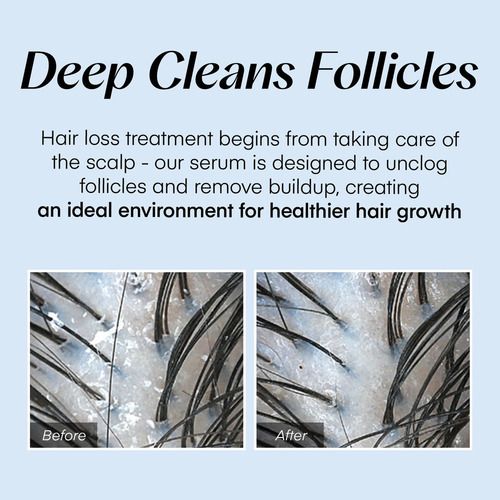 Use O Sérum Tópico De Tratamento De Crescimento Capilar