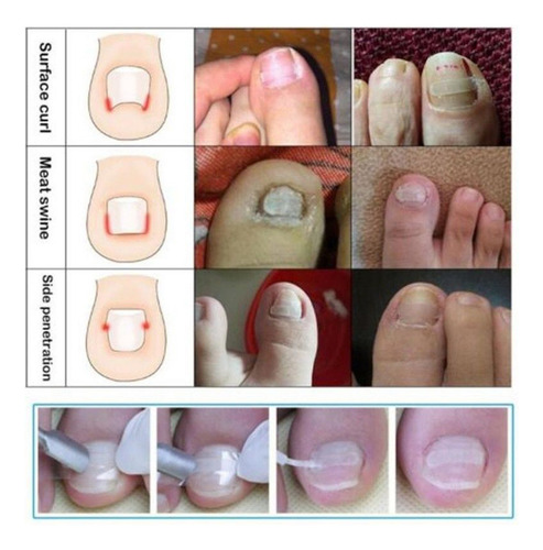 Parches De Corrección De Uñas Pies Encarnadas. Herramienta