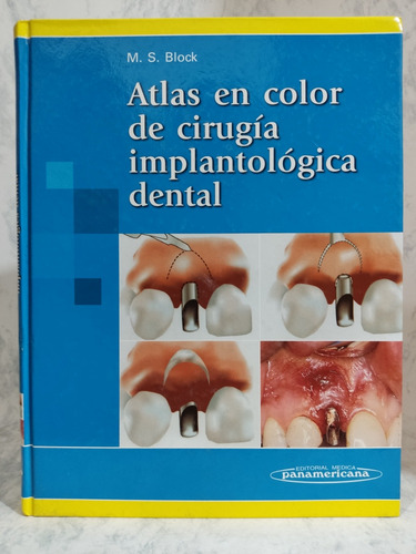 Atlas En Color De Cirugía Implantólogica Dental, M. S. Block