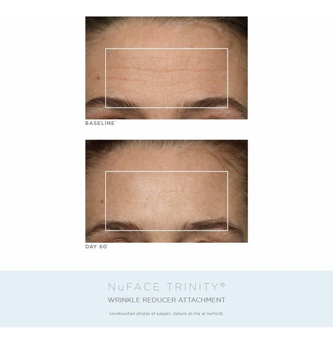 Nuface Trinity Complete - Kit De Tonificación Facial
