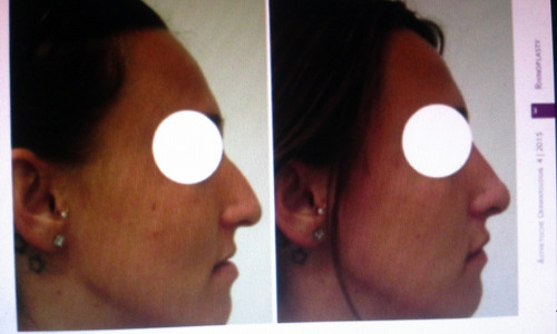 Imagen 6 de 6 de Remodelacion Facial Con Acido Hialuronico. 098 173 504