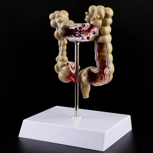 Para Para Modelo De Intestino Grueso Con Lesión De Colon