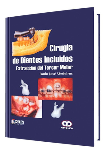 Cirugía De Dientes Incluidos. Extracción Del Tercer Molar.