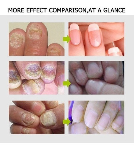 Imagen 3 de 6 de Gel De Uñas Efero De 7 Piezas, Tratamiento Eficaz Para Mi