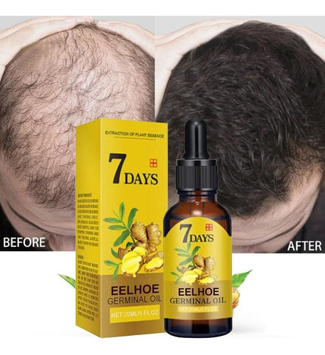Tratamento De Calvície Cura Cabelo Careca Nasce Freeshipping