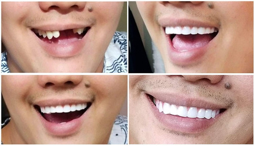 Dientes Articiales