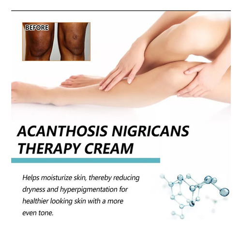 // Yiyi Creme Para Acanthosis Nigricans 6 Caixas