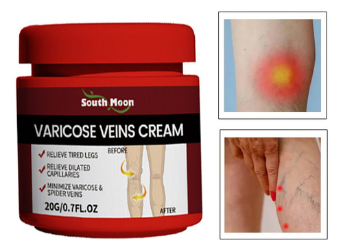 Crema Para Venas Varicosas, Trombosis, Vasculitis 20 Gr