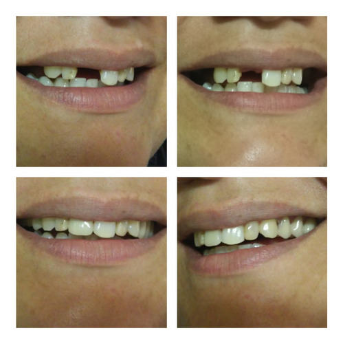 Imagen 2 de 5 de Prótesis Dentales - Dentista - Placas Contencion Y Bruxismo