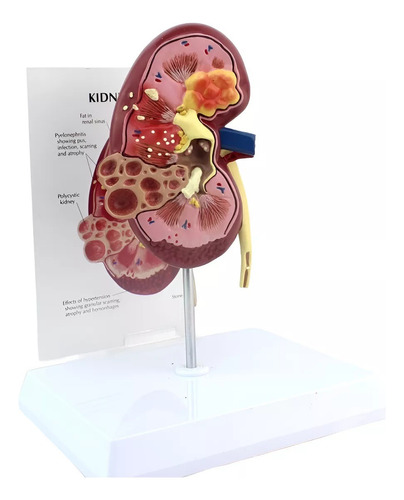 Modelo Anatômico P/ Estudo Rim Com Patologia