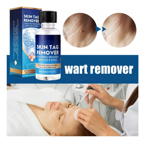 Nitrógeno Líquido Antiwart, Eliminador De Moho, 20 Ml