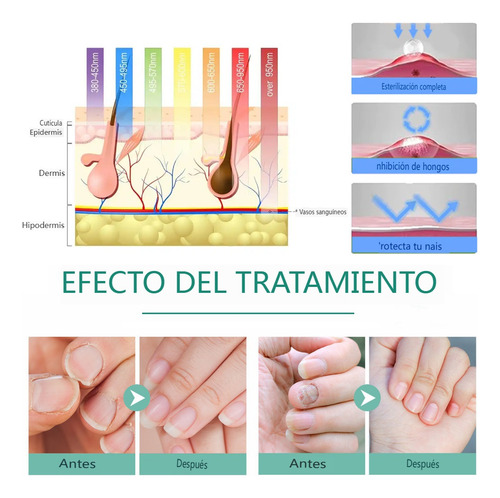 2×dispositivo Láser Limpieza Uñas Para Onicomicosis A