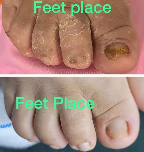 Fungicida Tea Tre, Onicomicosis, Hongos Uñas, Pie De Atleta
