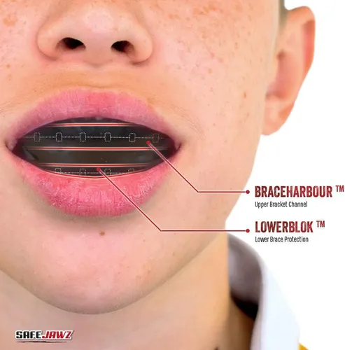 Protección Bucal Safejawz P/ortodoncia, Talla Única Remolde.