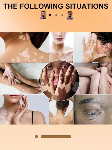 Crema Tratamiento Profesional Para Eliminar El Vitiligo Original