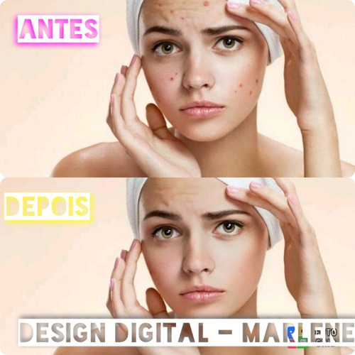 Imagem 1 de 1 de Remover As Manchar Do Rosto
