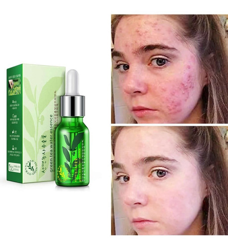 Serum Loción Anti Acné Barros Espinillas Hidratante Protege