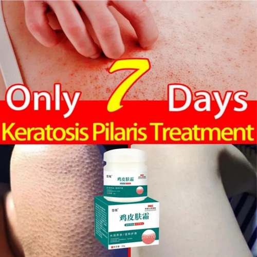 Loción Corporal Curando La Queratosis Pilaris/kp/ Chicken Sk