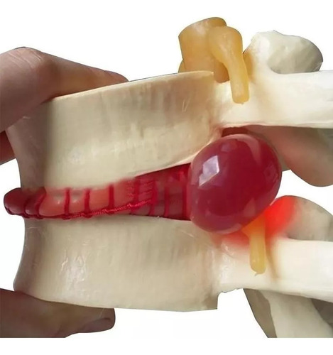 Anatomía Disco Lumbar Columna Vertebral Modelo Enseñando2024