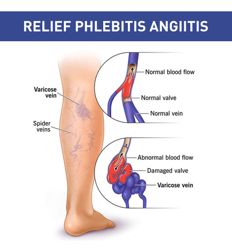 L Varicose Vein Patch Varicose Vein Patch Spider Vein Legs S