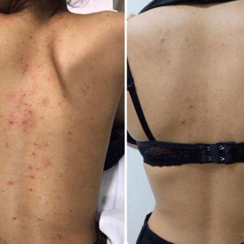 Kit Body Talco (quita Manchas, Aclara La Piel, Sin Arrugas)