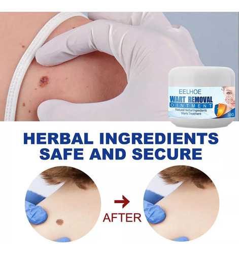 L Creme Removedor Verrugas E Toupeiras-