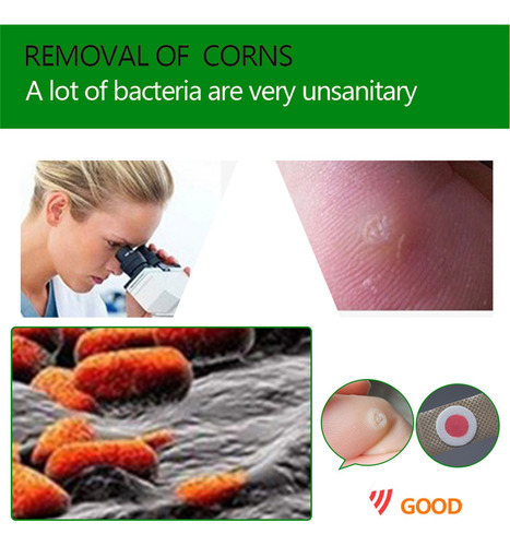 Q Corn Paste Removes Corns, Blisters, And Feet Corns Re 6254