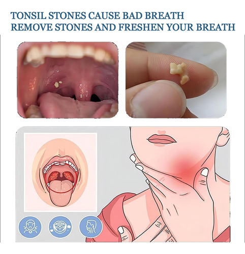Tonsil Stone Remover Tool - Tonsil Stone Remover Vacuum Kit