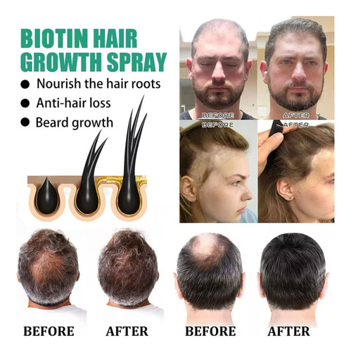 - Óleos De Crescimento Em Spray Para Cabelo Anti-queda De