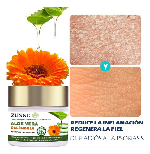 Crema Psoriasis Y Dermatitis / Aloe Vera Puro / Caléndula