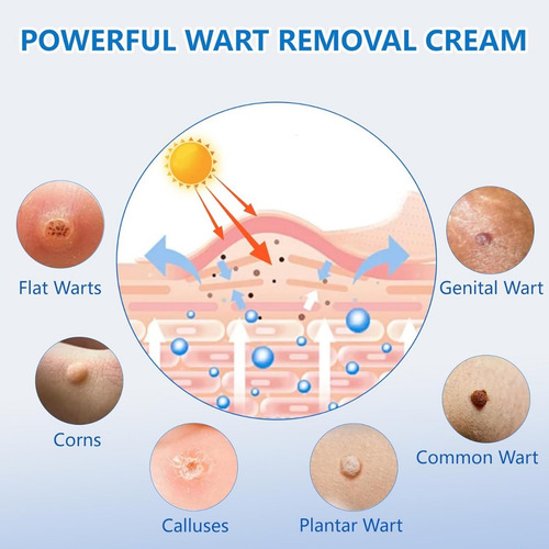 Crema Para Eliminar Verrugas - Acción Rápida