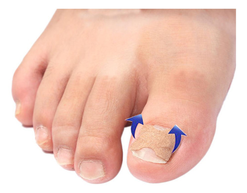 Xfw2 Toe Corrector Stickers Fixer Herramienta De 5 Hojas