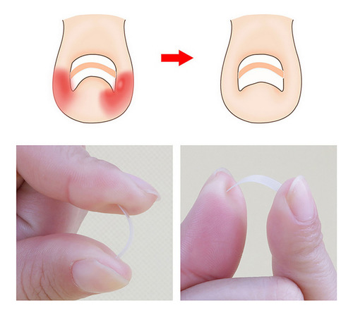 Set De Corrección De Uñas Encarnadas, Tratamiento Para Uñas