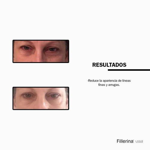Imagen 6 de 9 de Tratamiento De Relleno Fillerina Ojos Y Labios Grado 1