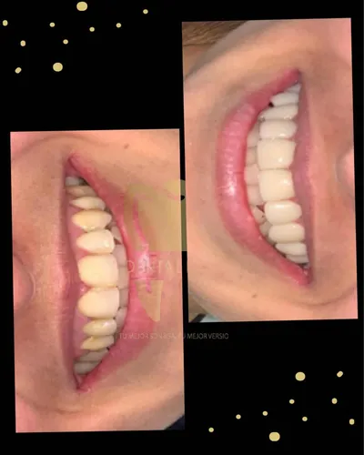 Carilla Dental En Resina (precio Por Unidad)