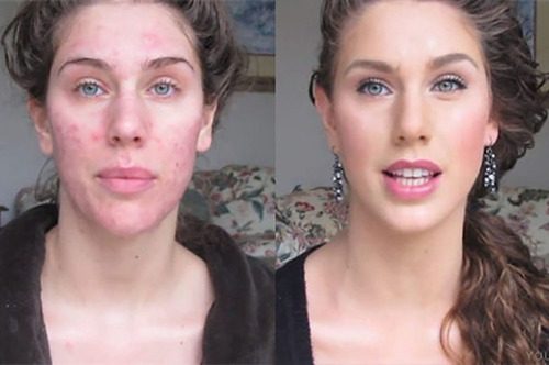 Imagen 3 de 4 de Acnepril Pildoras Para Eliminar El Cutis Curar El Acne