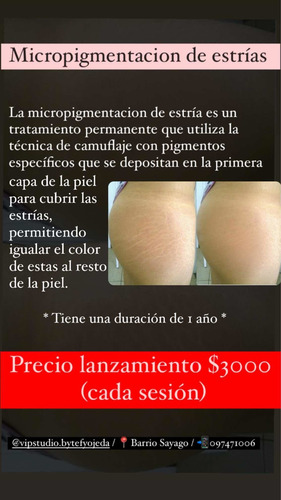Imagen 1 de 1 de Micro Pigmentación De Estrías