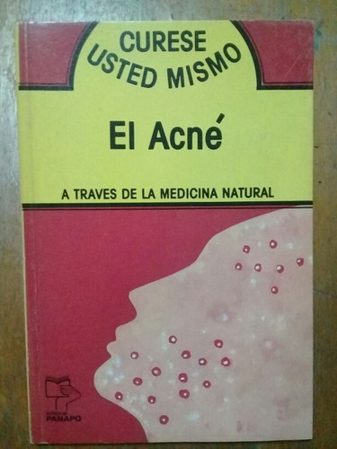 Curese Usted Mismo El Acne. Panapo