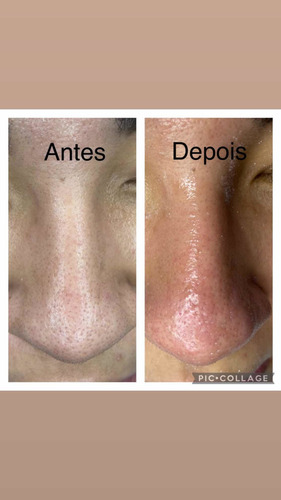 Imagem 3 de 4 de Limpeza De Pele Com Dermaplaing