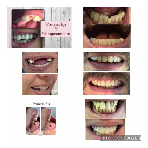 Imagen 5 de 5 de Prótesis Dental, Prótesis Fija