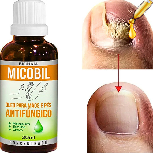 Micose No Pe Fungos Odor Micose Chulé Micose De Pele Cor Neutro